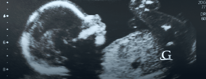 Ultrasound Of Baby Stock Photo