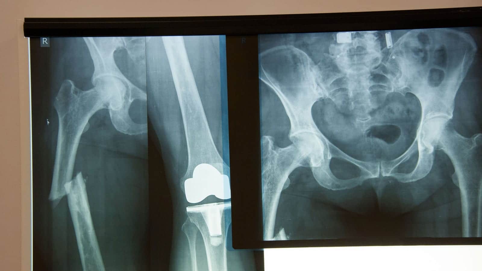 Knee & Hip Replacement Lawsuits