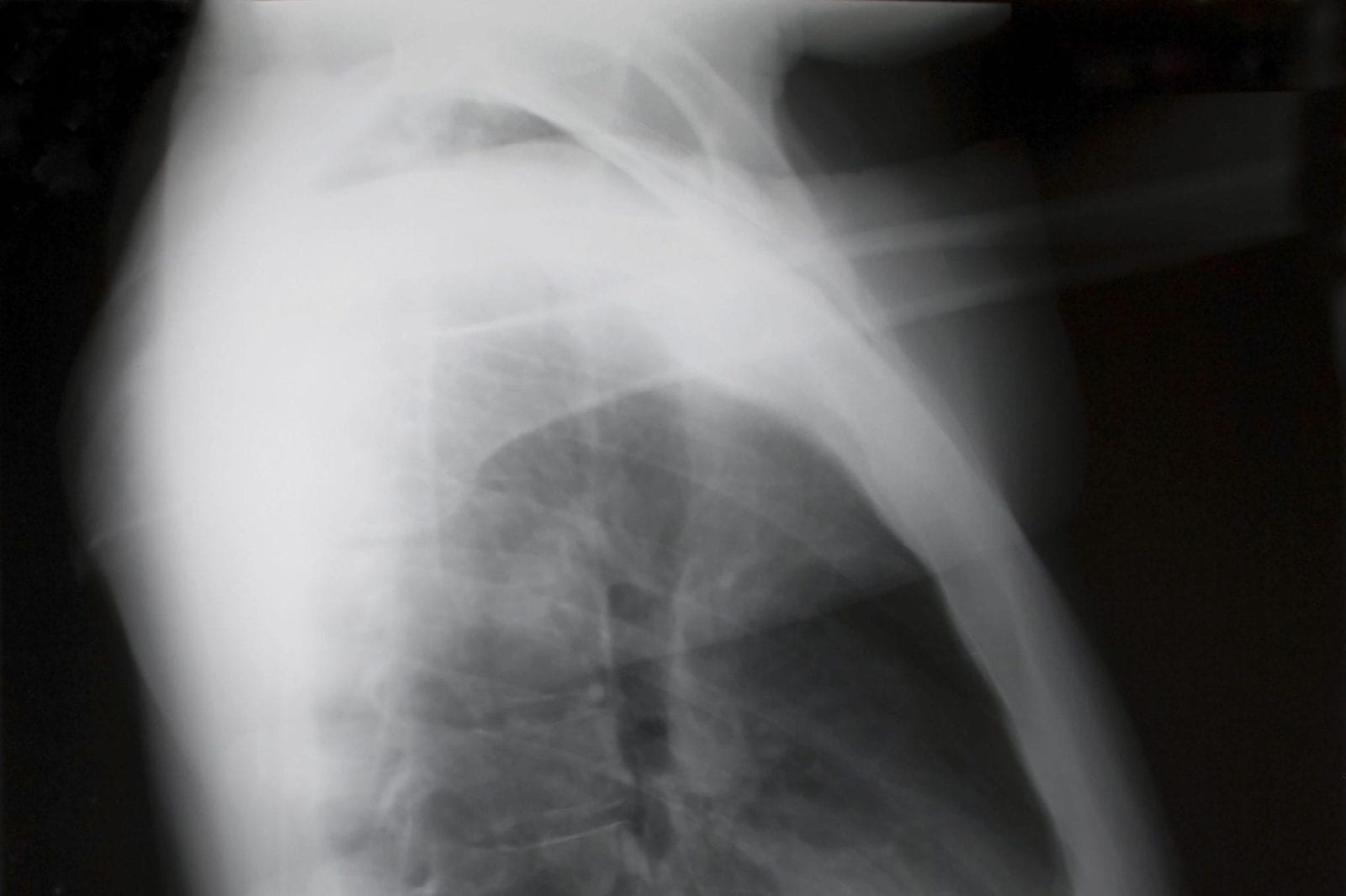 mesothelioma in the lungs - Goldwater Law Firm