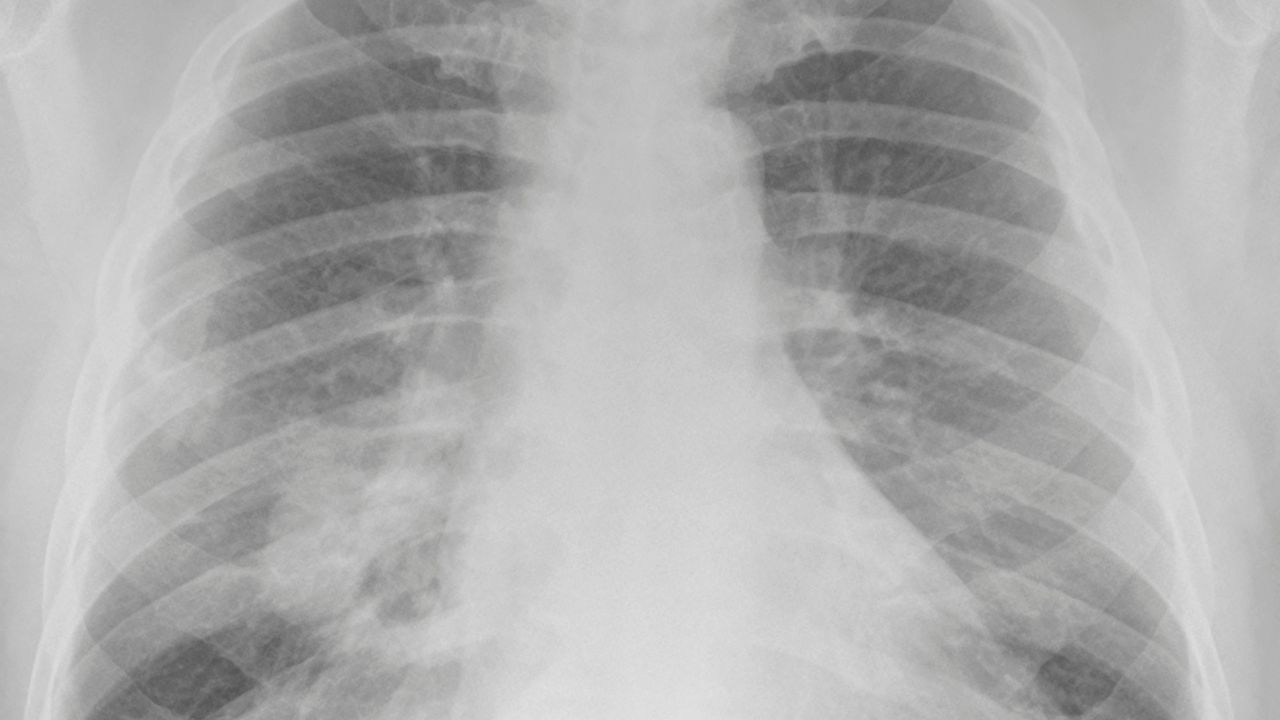 Asbestos Lung Cancer Lawsuit