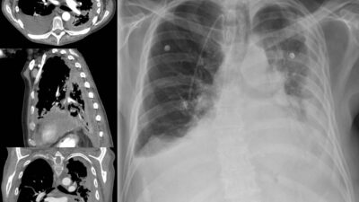 What’s the Difference Between an Asbestos Lawsuit and a Trust Fund Claim