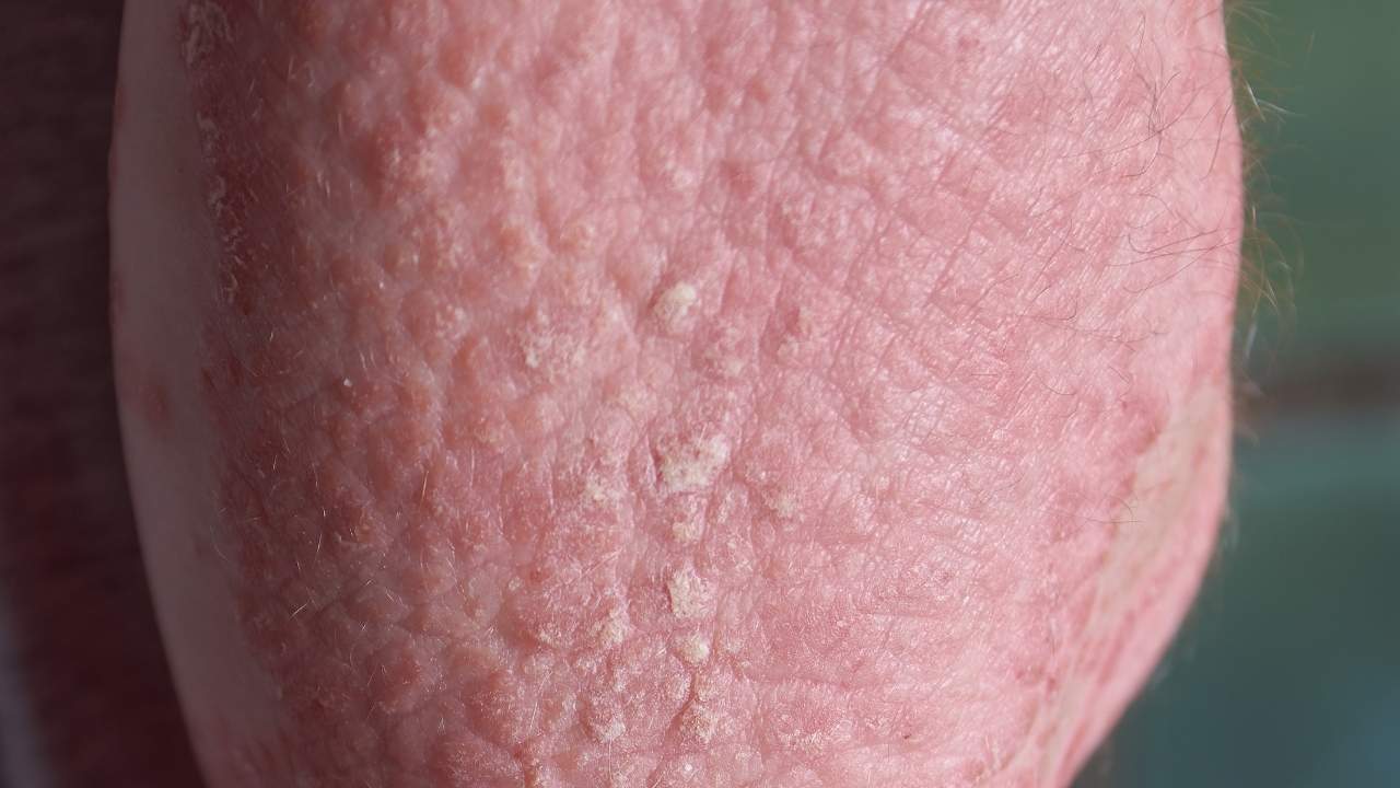 Dupixent CTCL & Skin Cancer Attorney