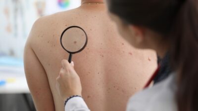 How to File a Dupixent Skin Cancer Lawsuit